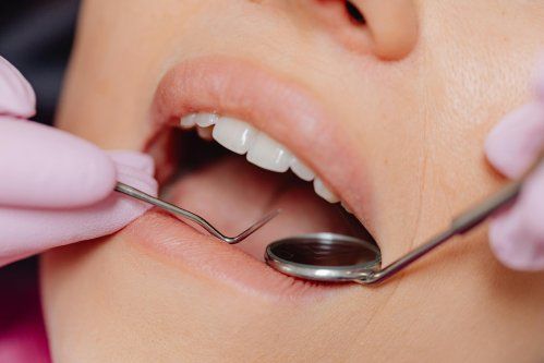 Las encías sangrantes pueden ser un síntoma temprano de gingivitis