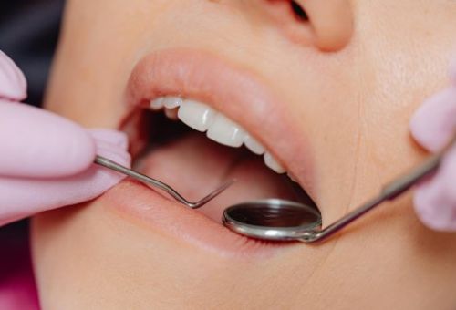 Las encías sangrantes pueden ser un síntoma temprano de gingivitis